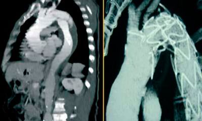 Cirugía de aorta torácica