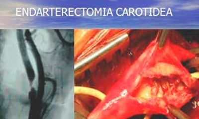 Cirugía carotidea